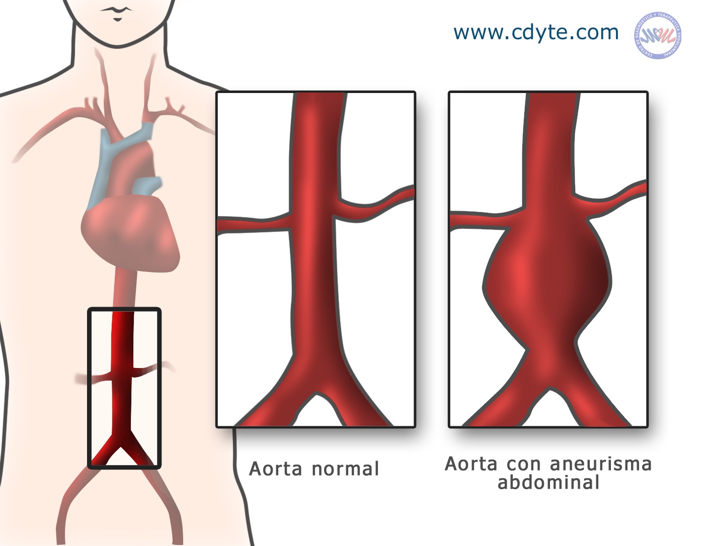 aneurisma aorta addominale DrBeckmann aneurisma aorta addominale DrBeckmann