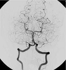 Arteriografia